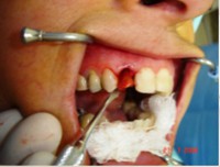 /album/galeria-de-fotos-carga-imediata-apos-exodontia-atraumatica-/carga-imediata-com-exodontia-atraumatica3-jpg/